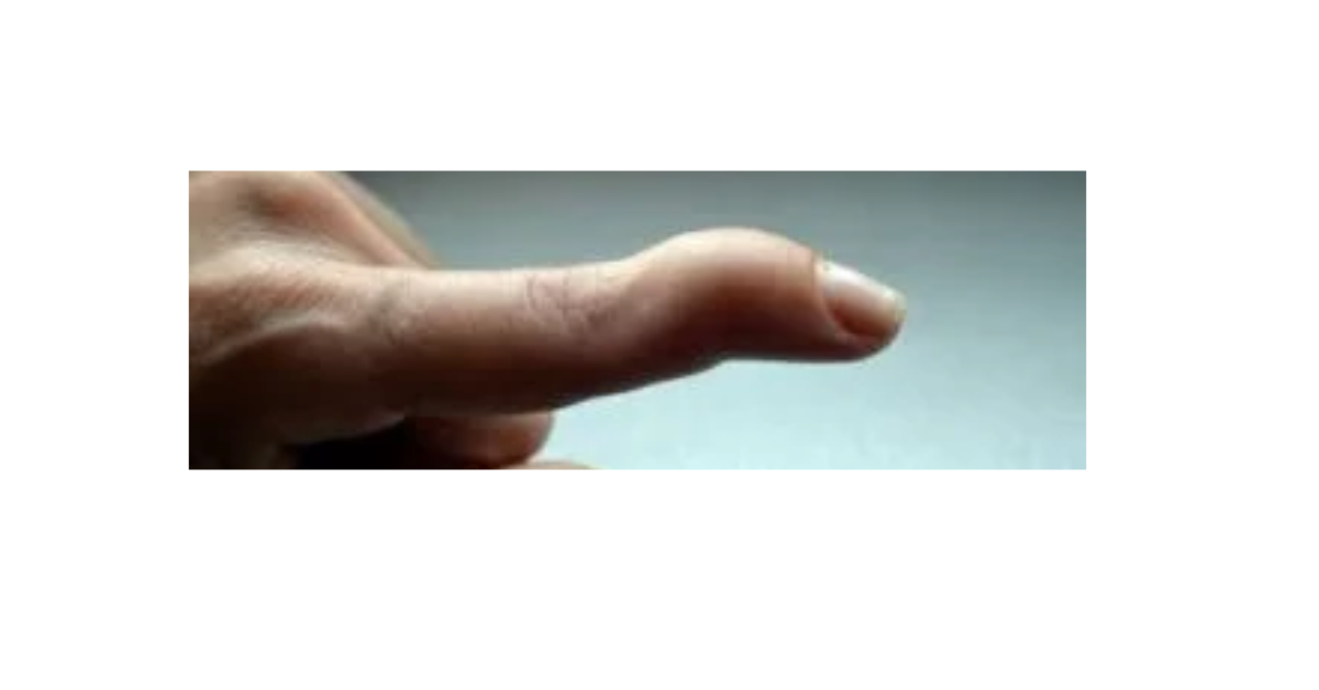 Lesión de los tendones extensores de la mano