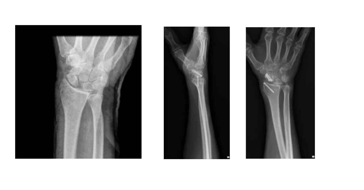 Fractura del escafoides